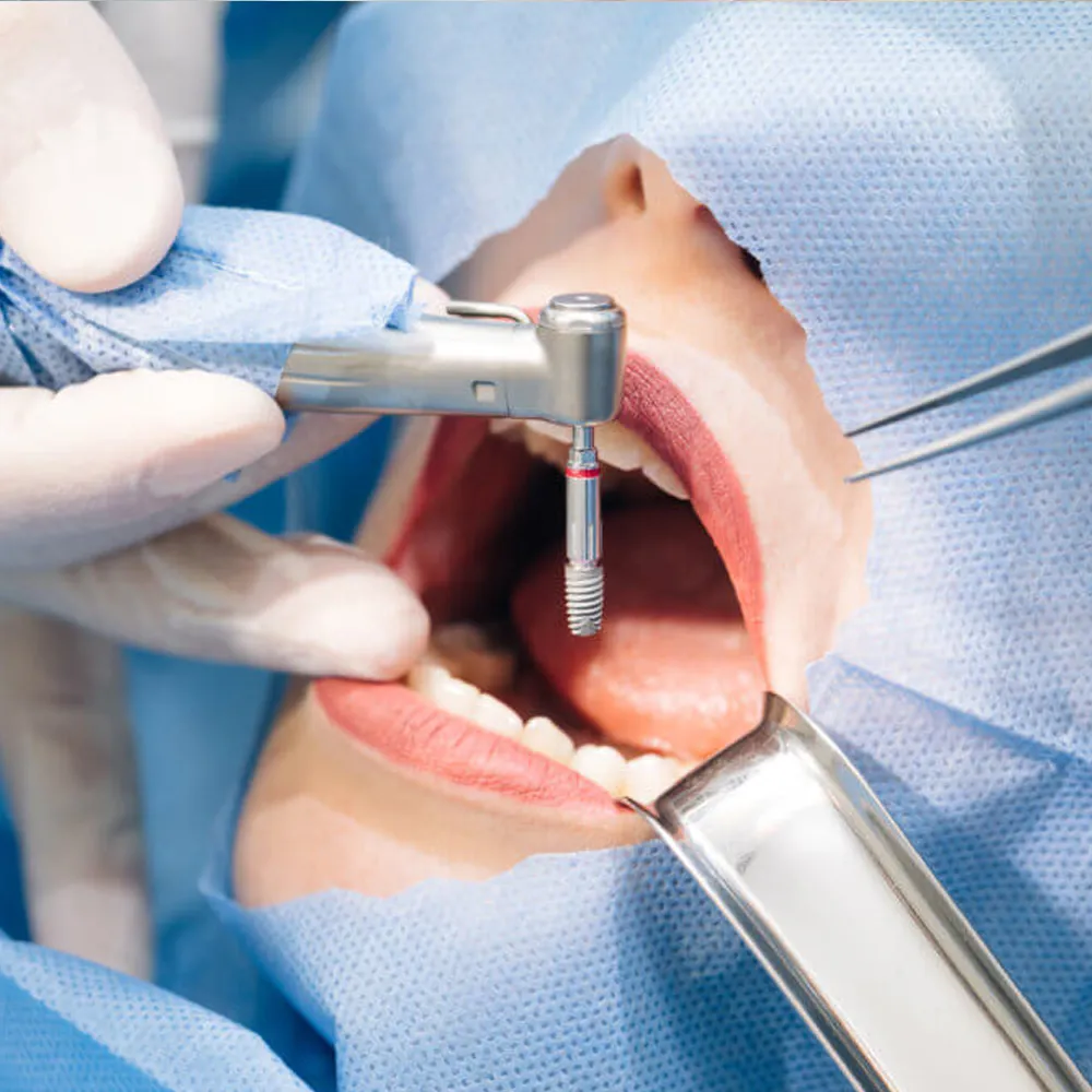 Contre-angle Dentaire Woodpecker 20:1 Pour Implant - Modèle WP-1L - Neuf